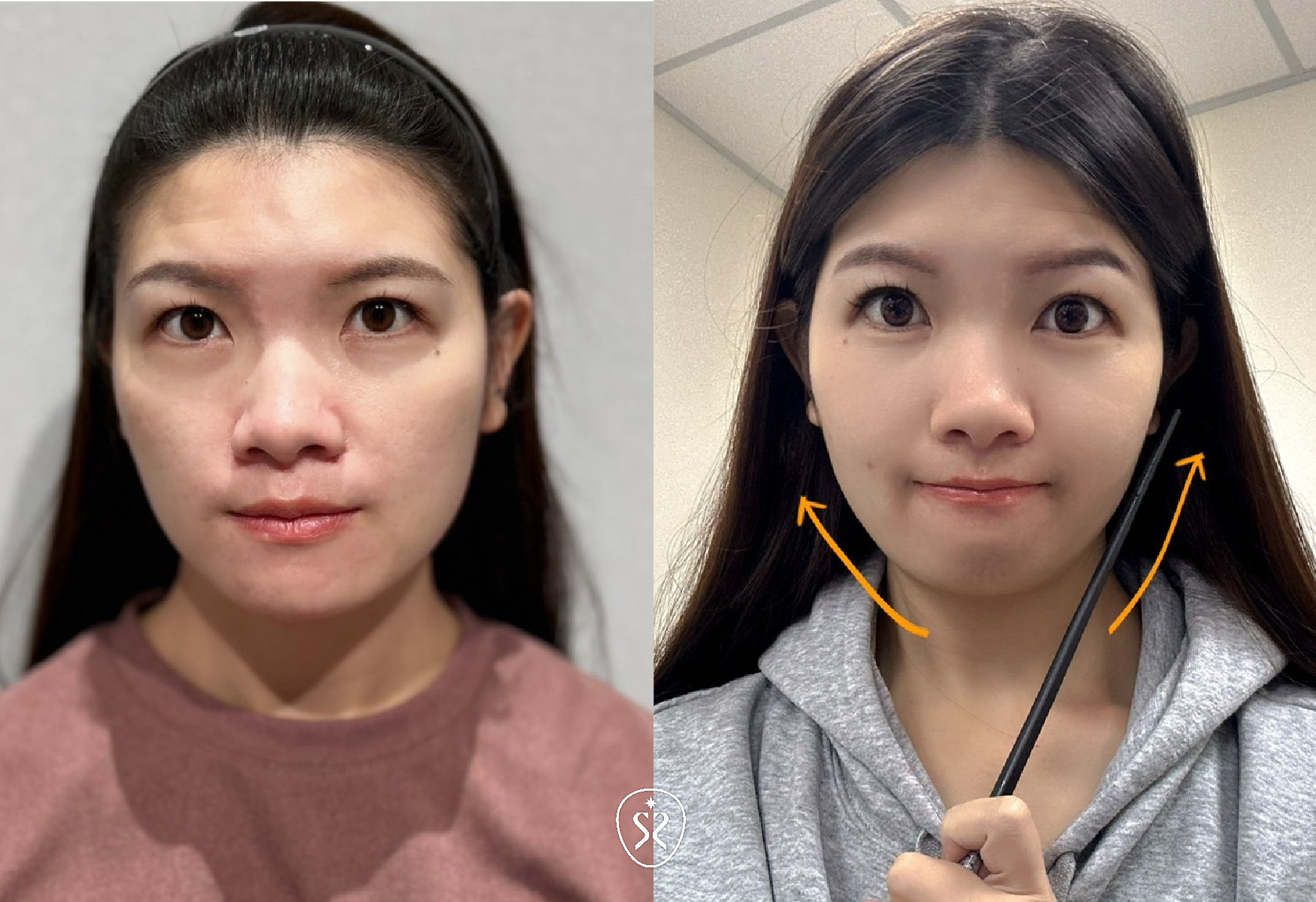 玩美電波的效果可將臉部肌膚收緊，讓臉看起來更緊緻更加柔順